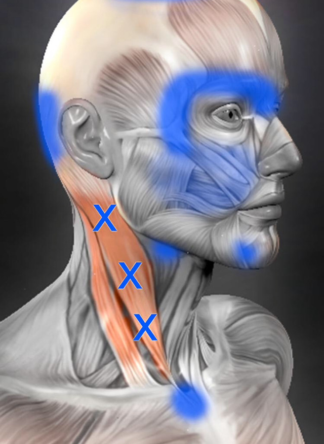 頸部の痛みに関連するトリガーポイント 神門鍼灸整骨院 甲子園院