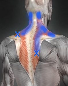 肩甲間部の痛みに関連するトリガーポイント 神門鍼灸整骨院 甲子園院