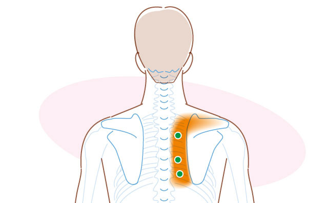 肩甲間部の痛みに関連するトリガーポイント 神門鍼灸整骨院 甲子園院