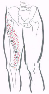 大腿部内側の痛みに関連するトリガーポイント 神門鍼灸整骨院 甲子園院
