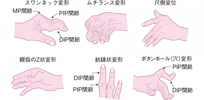 関節 リウマチ で 正しい の は どれ か