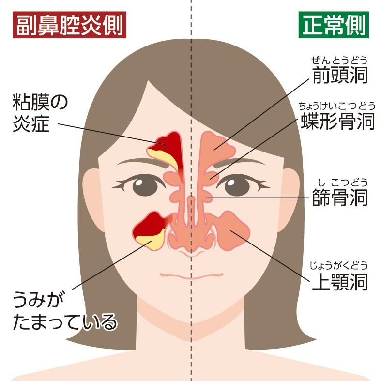 副 鼻腔 炎 ぼーっと する