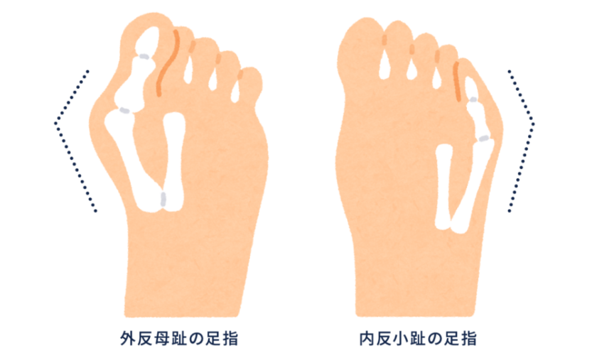 外反母趾と内反小趾の原因について①